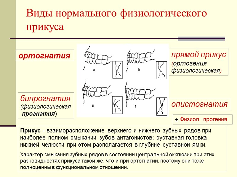 ортогнатия Виды нормального физиологического прикуса бипрогнатия (физиологическая  прогнатия)  опистогнатия прямой прикус (ортогения
